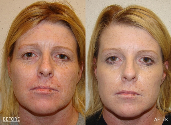 Microneedling Before & Afters