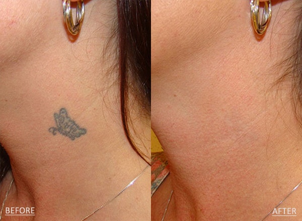 Laser Tattoo Removal Before & After Photos